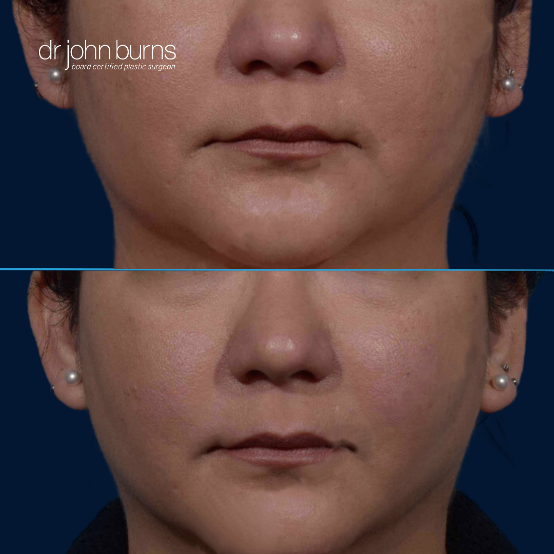 Before and after Buccal Fat Removal
