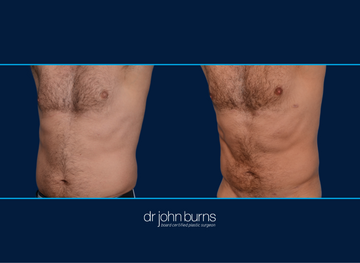 Before and After Male Liposuction | Dallas, Liposuction