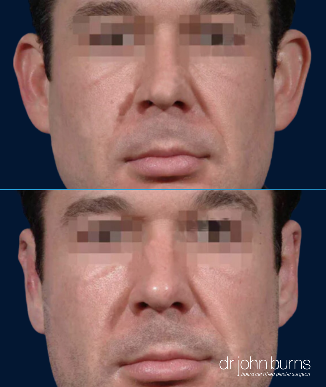 Before and after Male Otoplasty Results in Dallas, TX- Dr. John Burnss