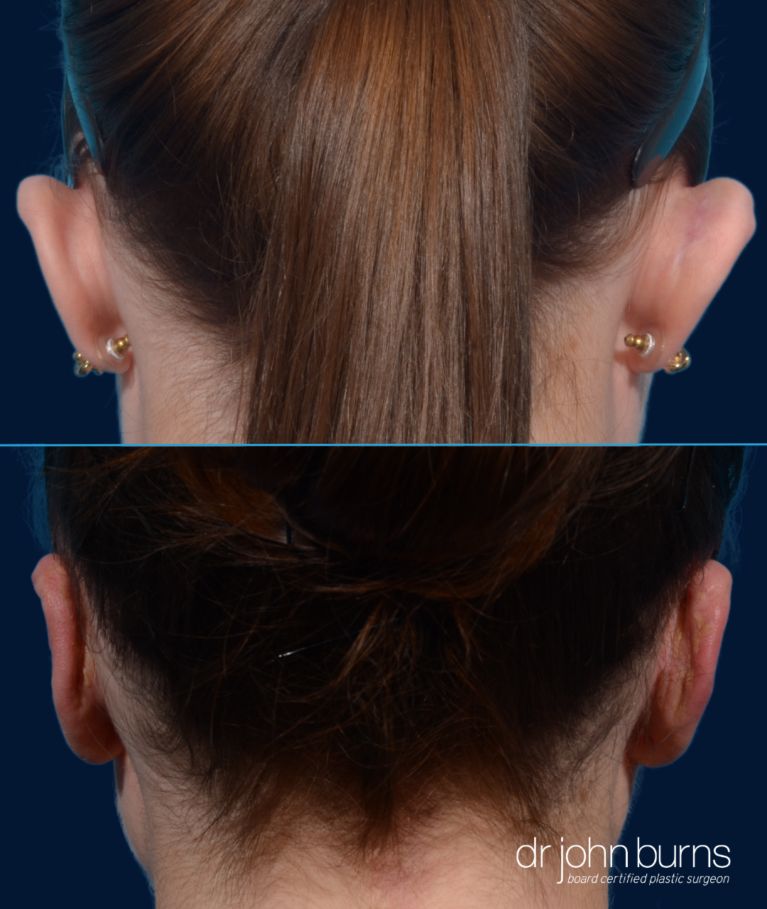 Female Before and After Otoplasty (Posterior Scalp) ear correction by Dr. John Burns