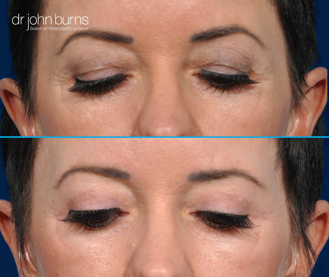 patient looking down, upper eyelid before and after results