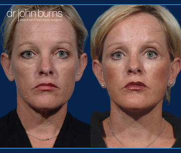Quad bleph before and after with mini facelift by Dallas Facelift surgeon, Dr. John Burns