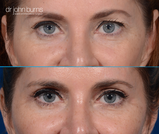 before and after eyelid surgery by dallas plastic surgeon, Dr. John Burn