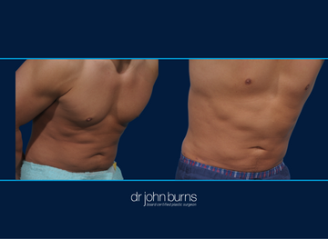 Male Liposuction Before and After | Dallas Ab Lipo by Dr. John Burns