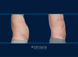 Right profile View | Male liposuction before and after, Dallas liposuction