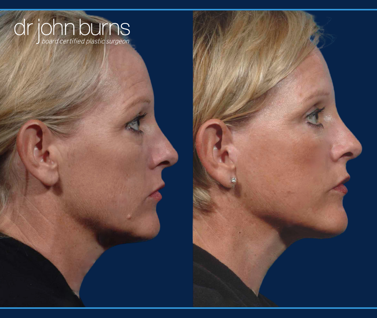 Profile View | Before and After Dallas Mini Facelift Results by Dr. John Burns