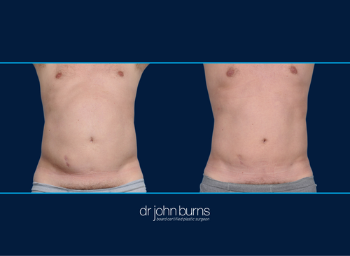 Male liposuction before and after, Dallas liposuction
