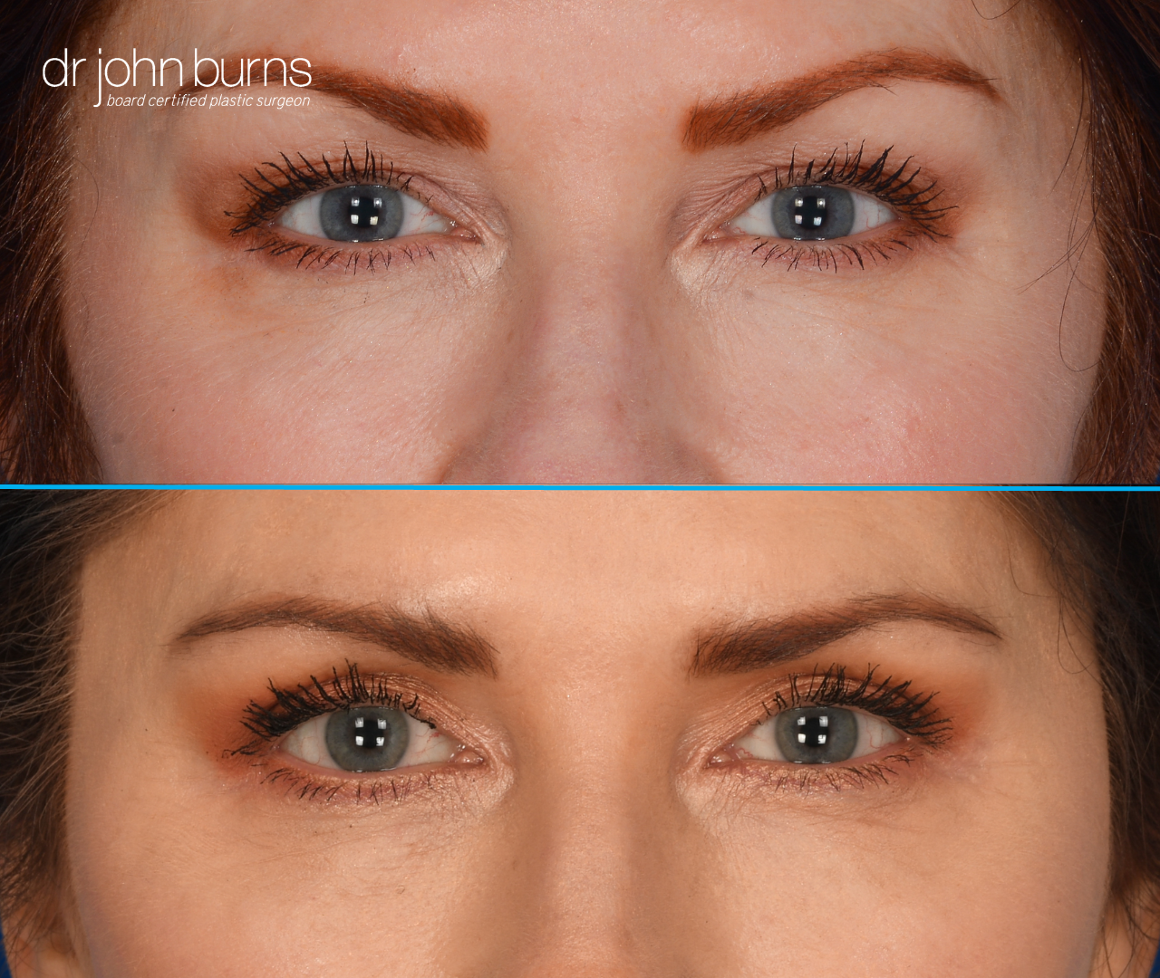 Upper eyelid before and after by Dr. John Burns