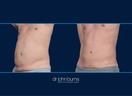 Male liposuction before and after, Dallas liposuction