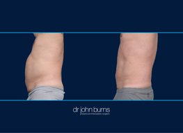 Left Profile View | Male liposuction before and after, Dallas liposuction