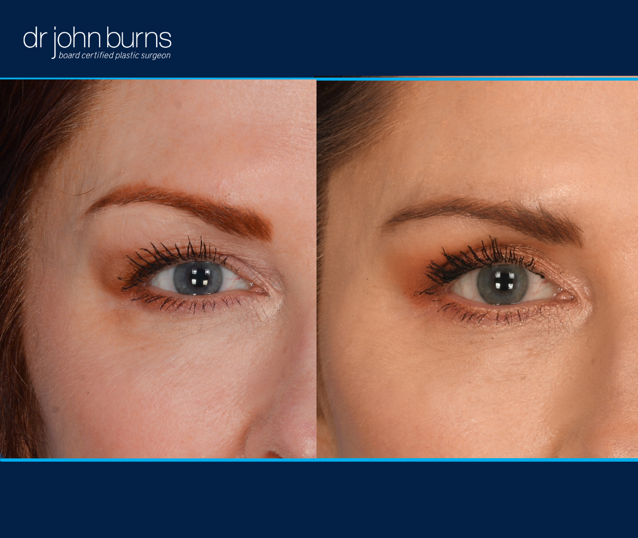 right eye view | before and after eyelid surgery in Dallas, Texas