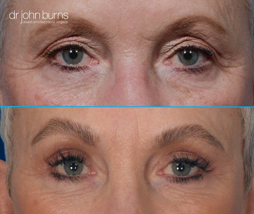 Upper eyelid before and after by Dr. John Burns