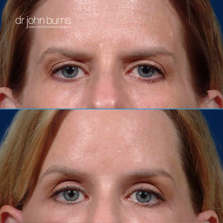 before and after brow lift by Dallas plastic surgeon, Dr. John Burns