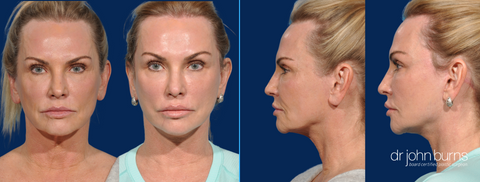 The Lift-and-Fill Facelift Technique, Dallas Texas