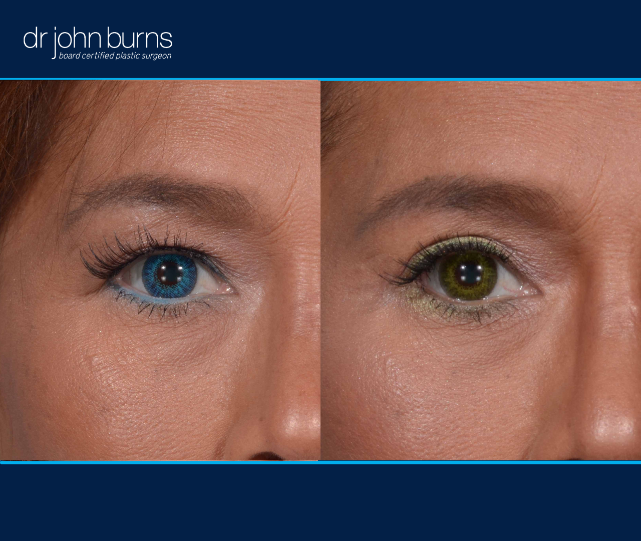 right eye view | before and after eyelid surgery results by Dr. John Burns