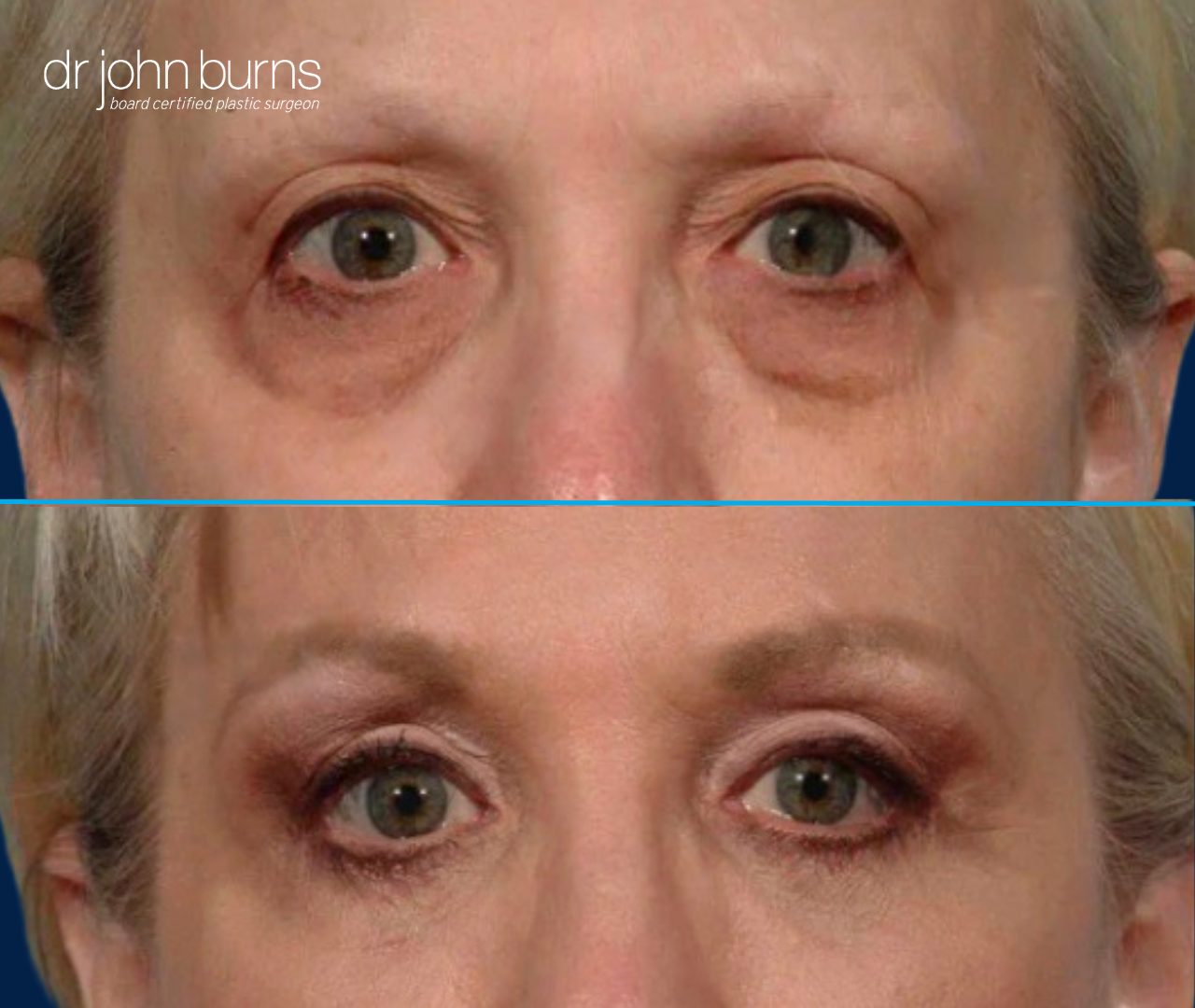 Upper eyelid before and after with canthopexy by Dr. John Burns