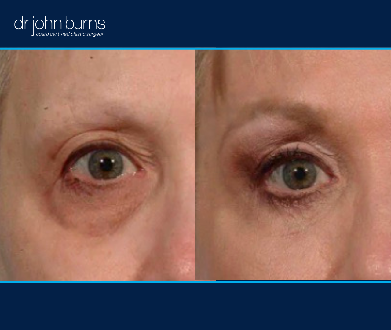 right eye view | before and after eyelid surgery results by Dr. John Burns