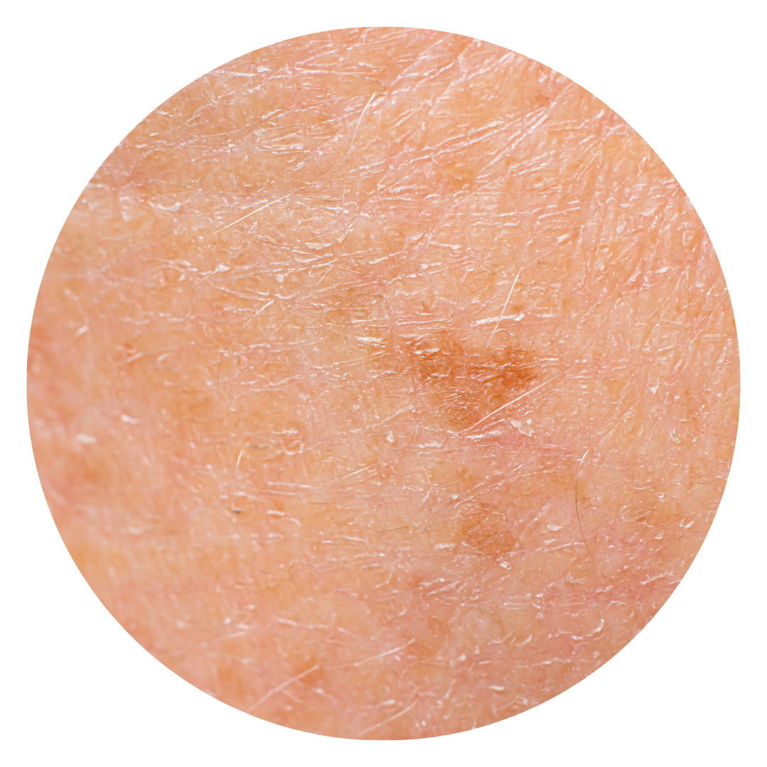 caucasian skin with solar lentigines/brown age spots