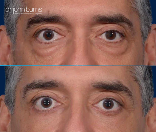 Upper eyelid before and after with canthopexy by Dr. John Burns