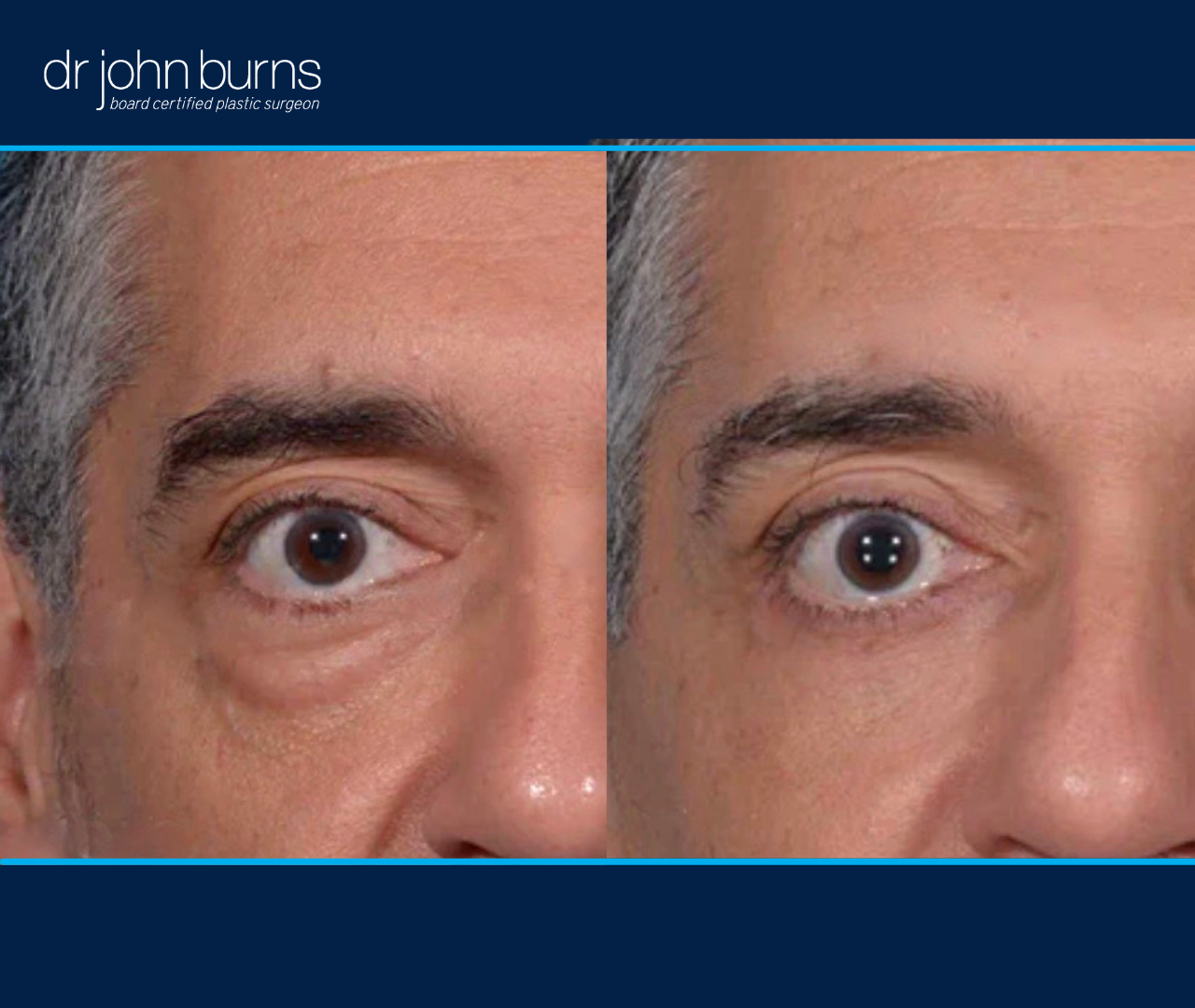 right eye view | before and after eyelid surgery results by Dr. John Burns