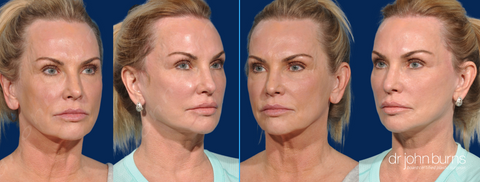 The Lift and Fill Facelift by Dr. John Burns, FACS in Dallas, Texas