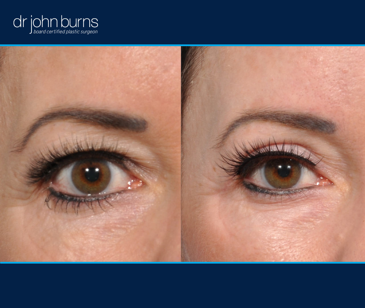 right eye view | before and after eyelid surgery in Dallas, Texas