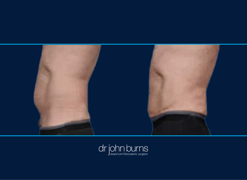 Before and After Male Lipo to Abs and Love Handles | Dallas Lipo by Dr. John Burns