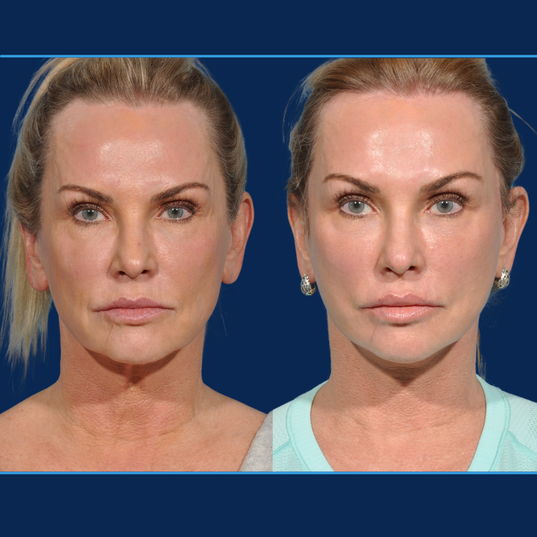 Before and After Revision Deep Plane Facelift