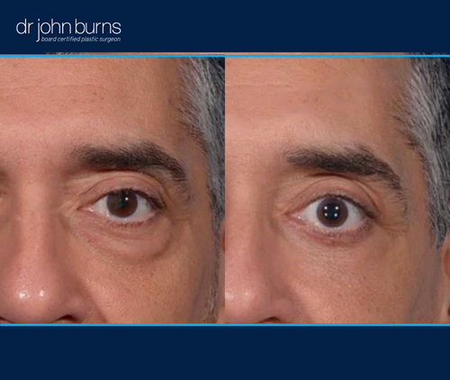 left eye view | before and after eyelid surgery in Dallas, Texas