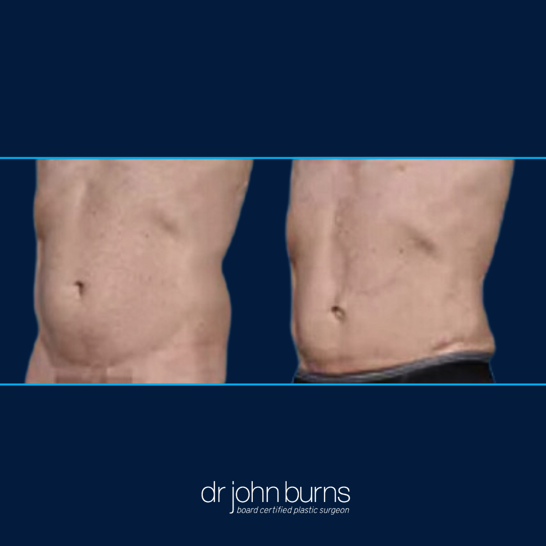 dallas male lipo before and after to chest, abs, and love handles by Dr. John Burns