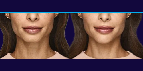 Before and after chin augmentation with Volux dermal filler, Dallas TX