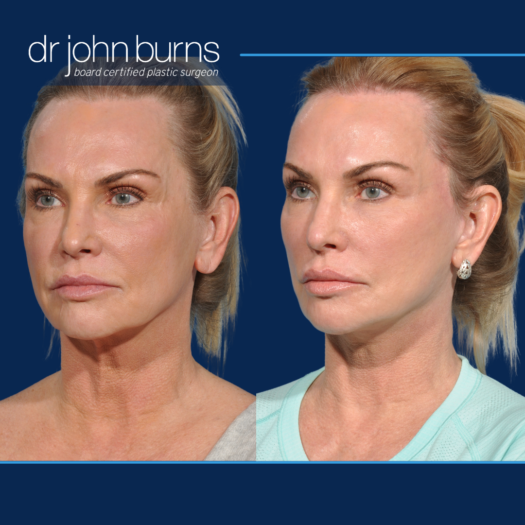 Left  Side View | Before and After Revision Deep Plane Facelift