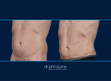 Before and After Male Lipo to Abs and Love Handles | Dallas Lipo by Dr. John Burns