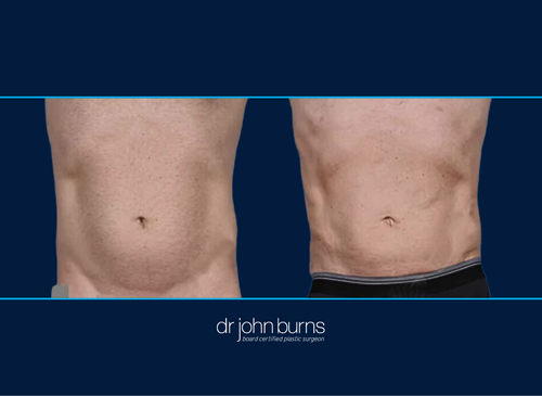 Before and After Male Lipo to Abs and Love Handles | Dallas Lipo by Dr. John Burns