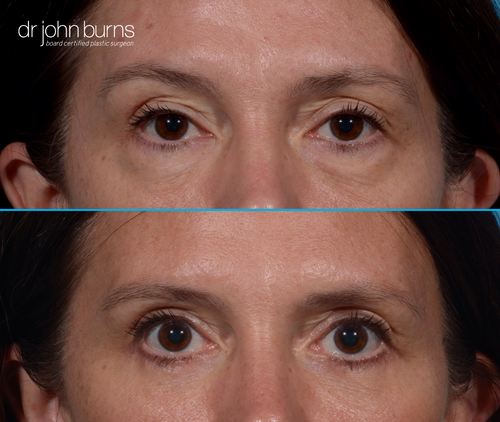 Upper eyelid before and after by Dr. John Burns