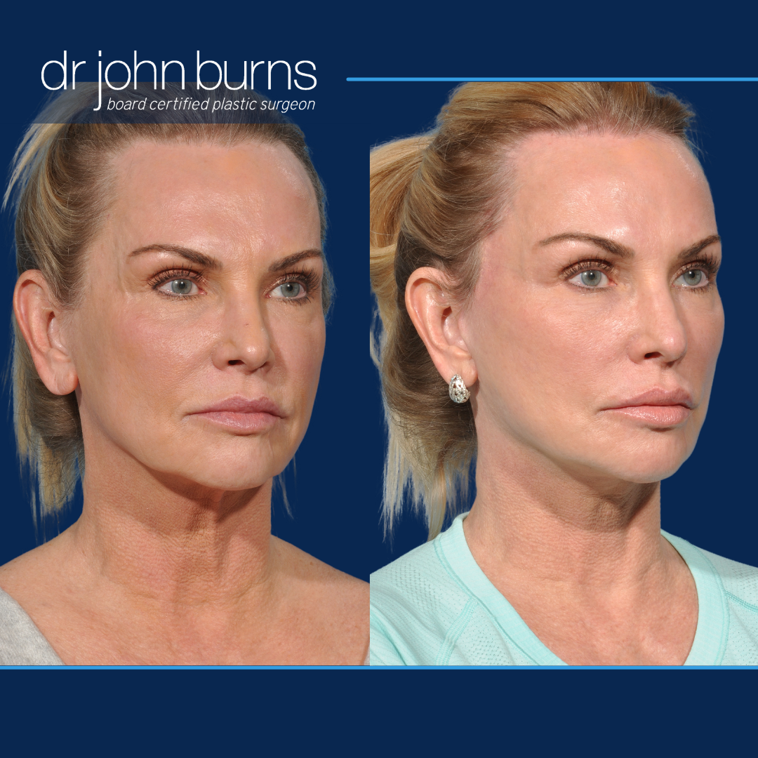 Right Side View | Before and After Revision Deep PlaneFacelift