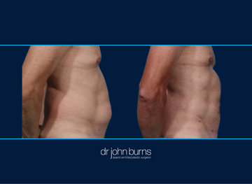 Male Liposuction Before and After | Dallas Ab Lipo by Dr. John Burns