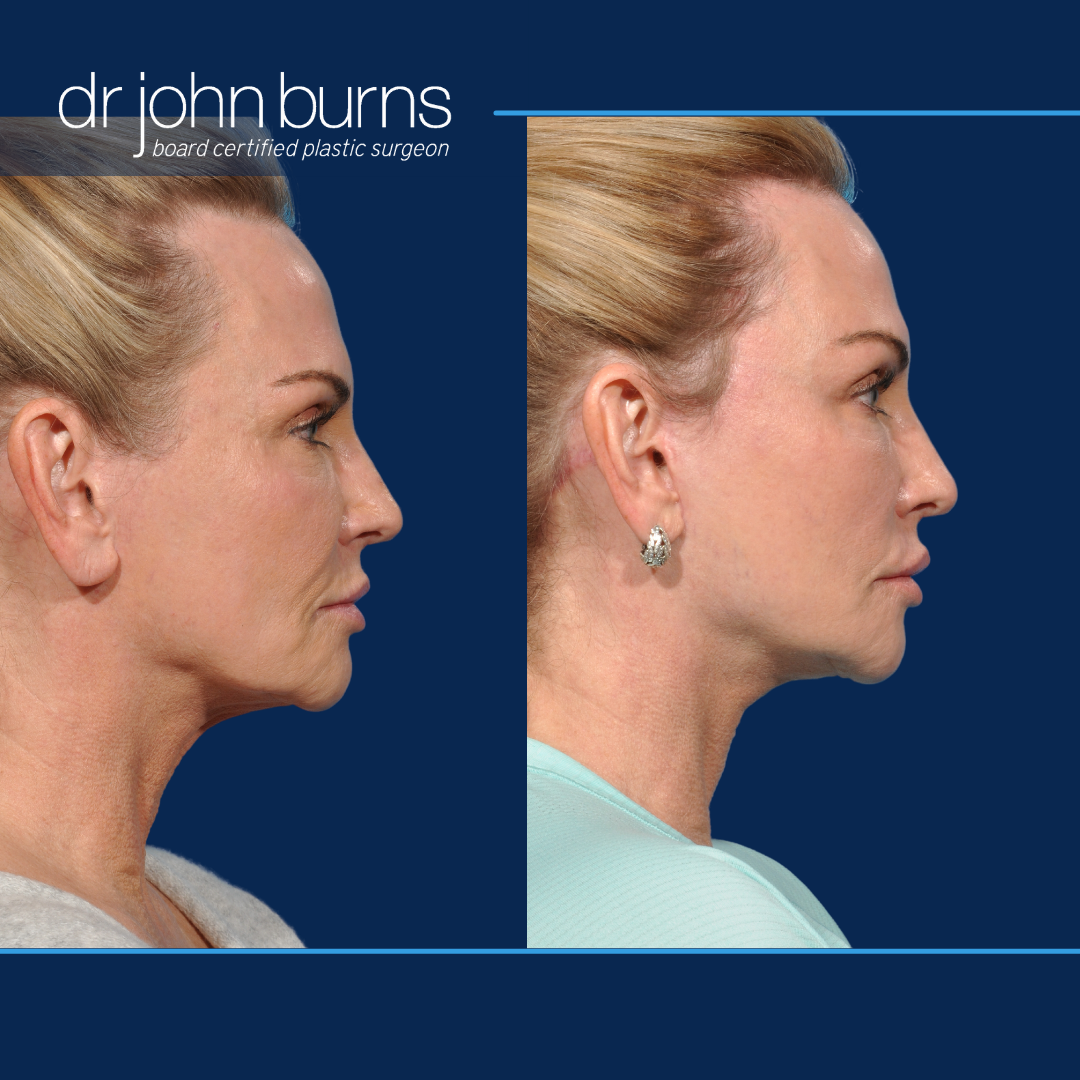 Profile View | Before and After Revision Deep PlaneFacelift