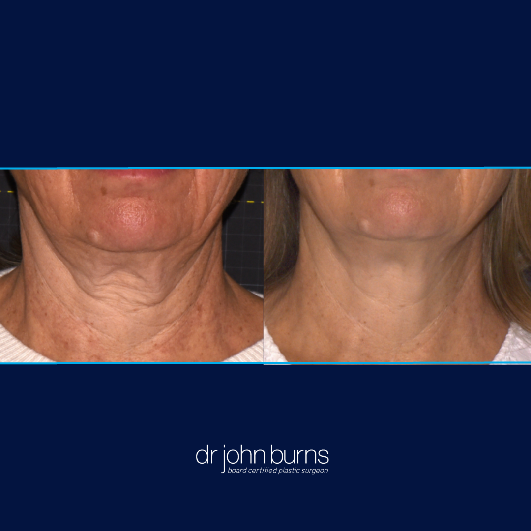 Sofwave Before and After Neck