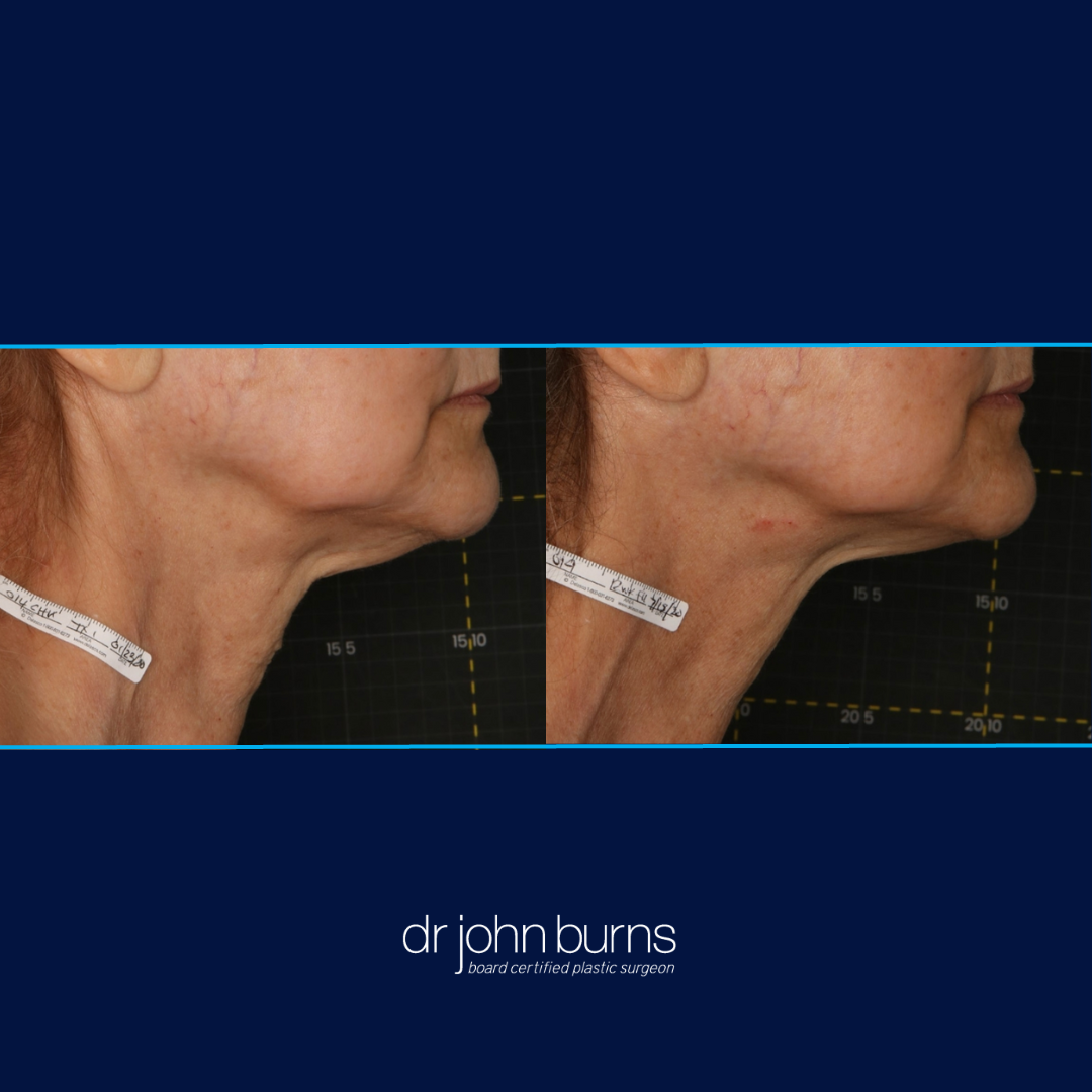Sofwave Before and After Neck