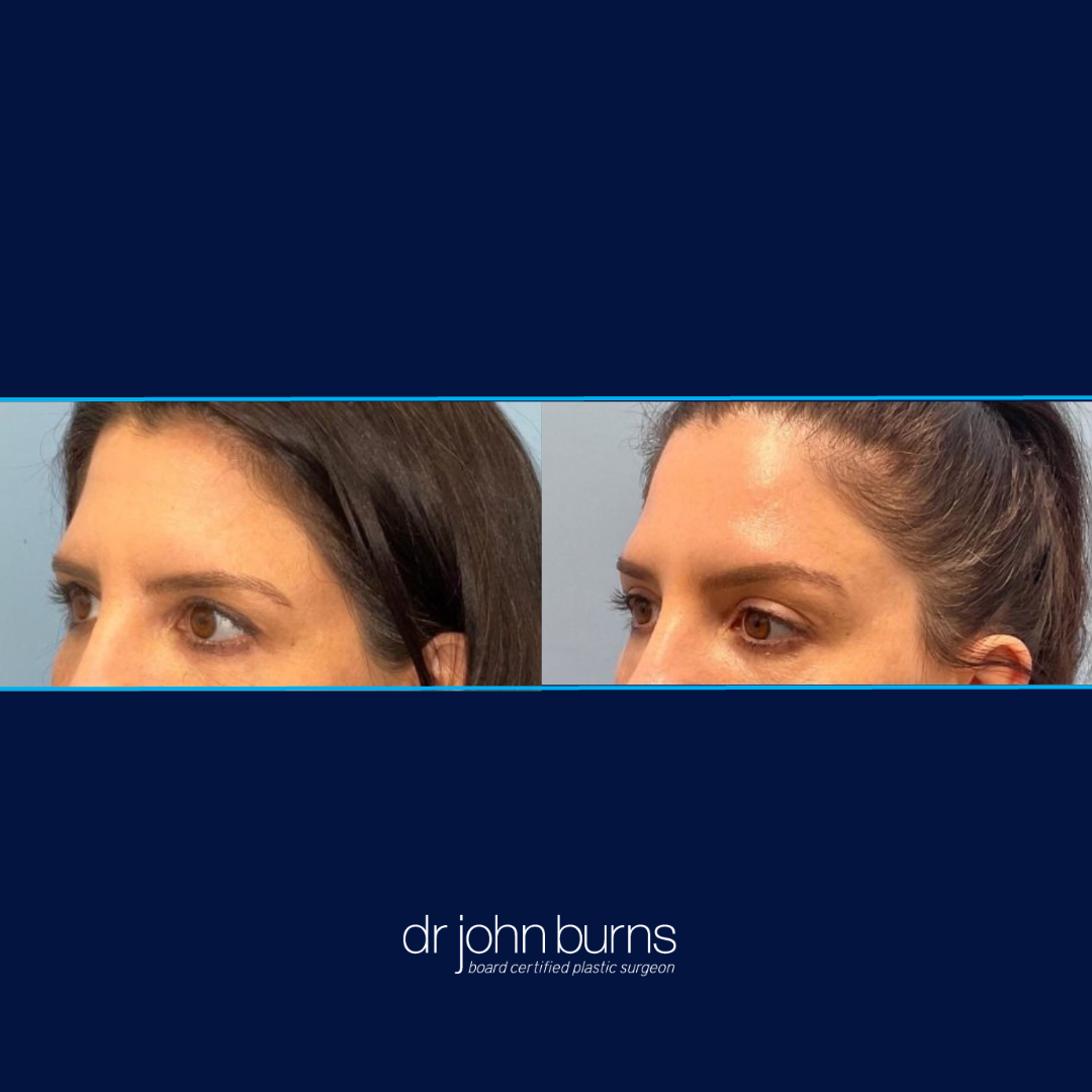 Sofwave Before and After Brows and Eyes