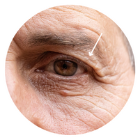 middle aged male eye with drooping excess skin and loose, crepey skin