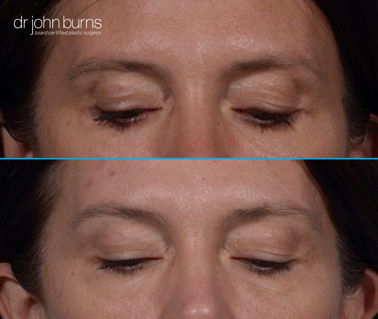 patient looking down, upper eyelid before and after results