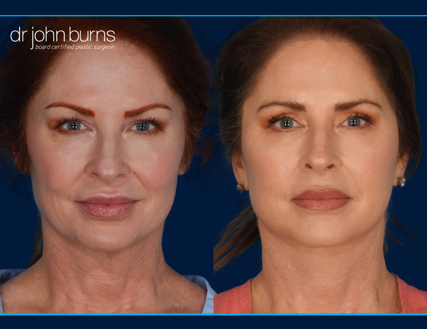 Facelift before and after by Dr. John Burns MD- Dallas Plastic Surgeon