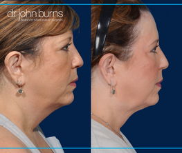 right profile view | before and after dallas neck lift