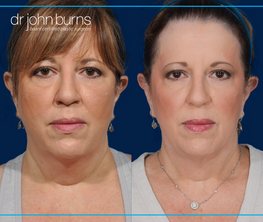 front view | before and after dallas neck lift