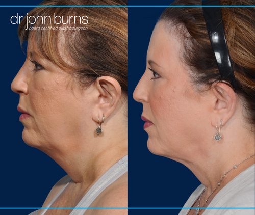 profile view | before and after dallas neck lift