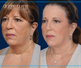 left 45 degree view | before and after neck lift results