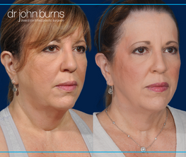 right 45 degree view | before and after dallas neck lift
