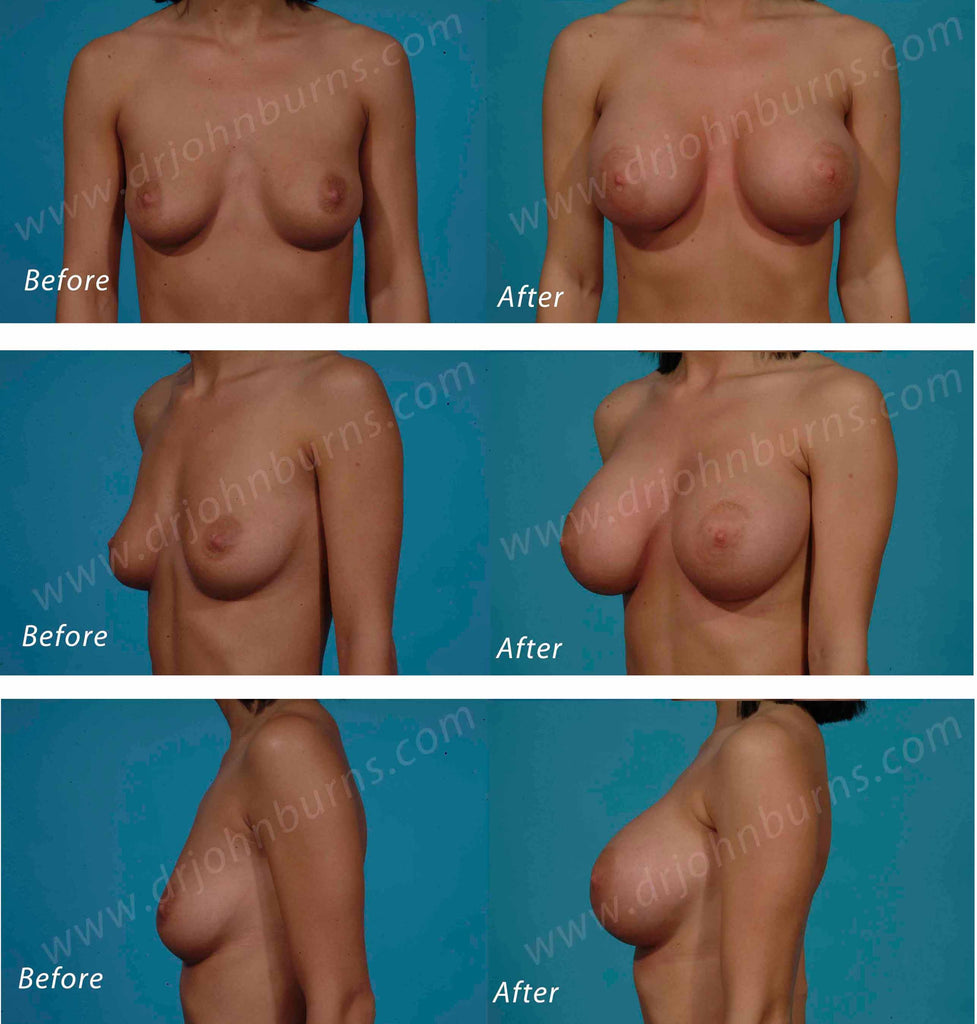 Breast Augmentation: A to D – Dr John Burns